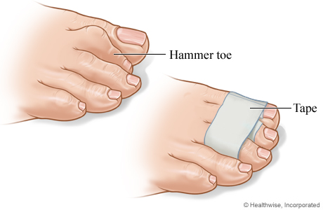 hammer toe symptoms