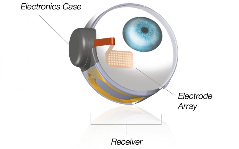 Diagram shows that an electronics case and electrode ray are positioned in the eye along with a receiver
