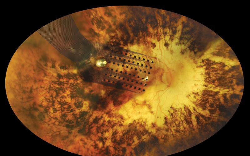 image of eye with electrode array placed into it
