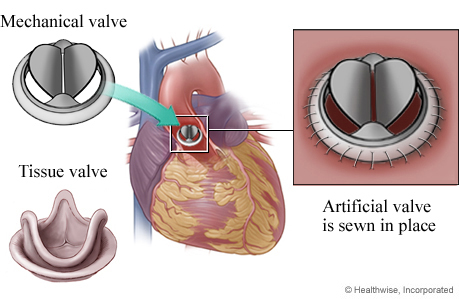 Mechanical valve and tissue valve, showing mechanical valve in heart, with detail of valve sewn in place