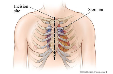 Chest incision site down the middle of the sternum from top to bottom of sternum