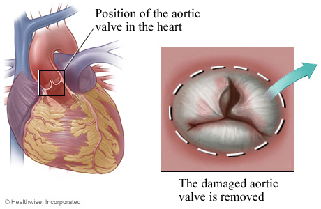 Location of aortic valve in the heart with detail of damaged valve
