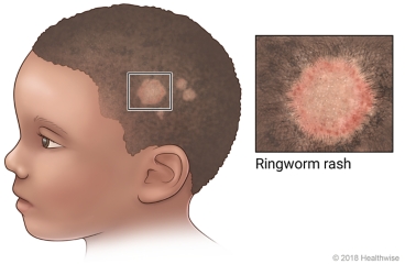 Close-up of ringworm rash on side of head