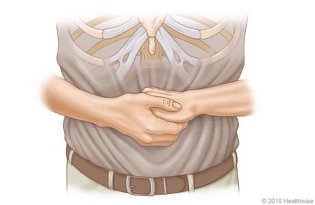 Choking rescue procedure (Heimlich maneuver) fist position