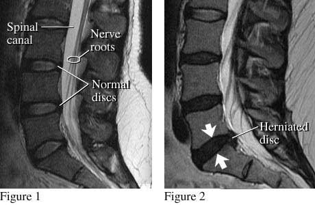 Images of normal discs and a herniated disc
