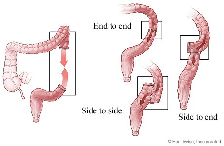 Ways the cut ends of the colon may be reattached