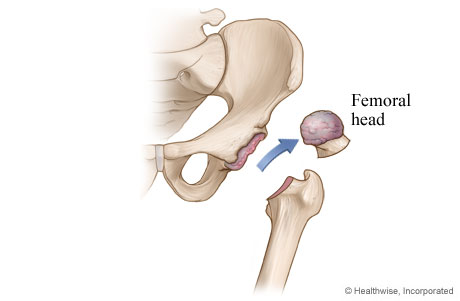 Hip replacement: Damaged cartilage and bone are removed