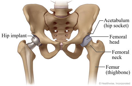 Hip with partial hip implant and normal hip showing the hip socket, femoral head and neck, and femur