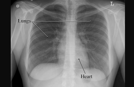 Image of a normal chest