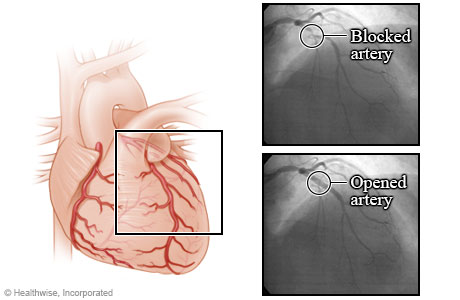 Arteries before and after an angioplasty