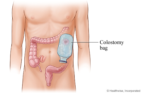 Colostomy pouch