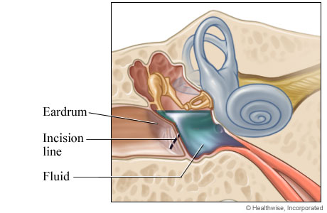 An incision made in the eardrum