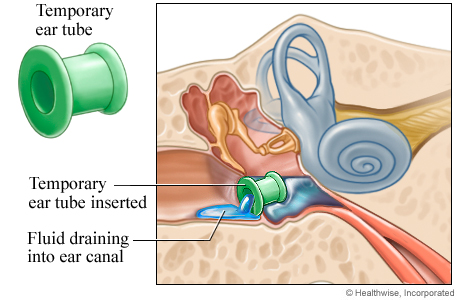 An ear tube in place and fluid draining into the ear canal