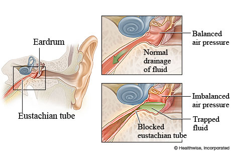 Normal and blocked eustachian tubes