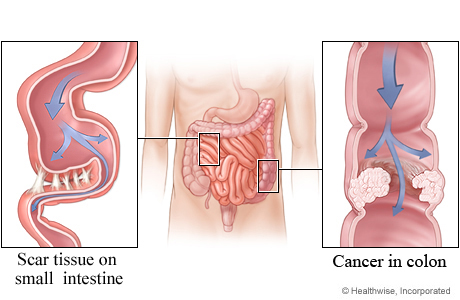 Obstructions in the small and large intestines