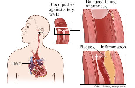How high blood pressure damages arteries