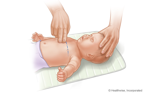 CPR on infant, showing placement of two fingers on breastbone