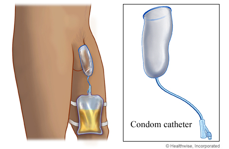 Condom catheter over penis draining urine from catheter to drainage bag secured on leg with straps