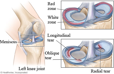 Meniscus healing zones and types of meniscus tears