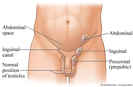 Types and positions of undescended testicles