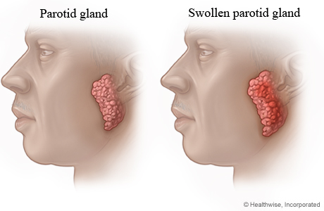 Normal parotid gland and swollen parotid gland