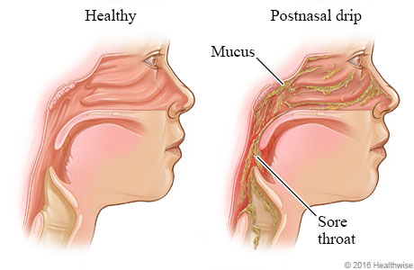 Inside view of head, showing the sinuses with postnasal drip draining into throat