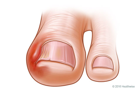 Big toe with an ingrown nail, showing redness and swelling