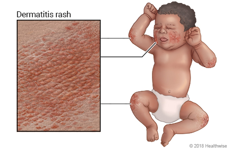 Baby with eczema, showing rash on elbows, cheeks, and knees