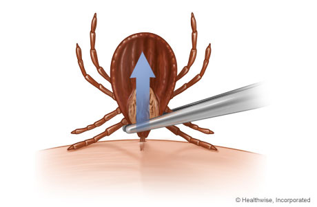 get rid of ticks