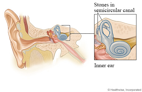 Ear anatomy, with detail of stones in semicircular canal