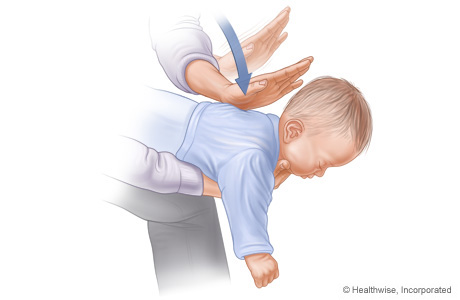 Picture C: Position of baby on arm for Heimlich maneuver, showing position and direction of back slaps