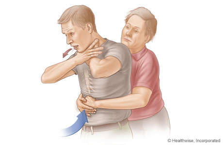 Picture B: Side view of Heimlich maneuver in an adult or child, showing position of hands and direction of thrust