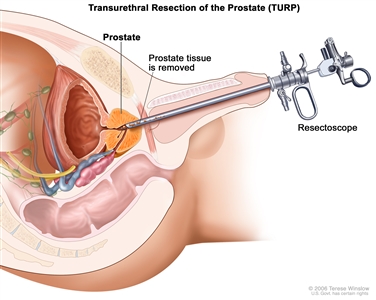 Transurethral resection of the prostate; drawing shows removal of tissue from the prostate using a resectoscope (a thin, lighted tube with a cutting tool at the end) inserted through the urethra.