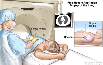 Fine-needle aspiration biopsy of the lung; drawing shows a patient lying on a table that slides through the computed tomography (CT) machine with an x-ray picture of a cross-section of the lung on a monitor above the patient. Drawing also shows a doctor using the x-ray picture to help place the biopsy needle through the chest wall and into the area of abnormal lung tissue. Inset shows a side view of the chest cavity and lungs with the biopsy needle inserted into the area of abnormal tissue.