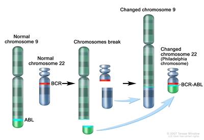 Philadelphia chromosome; three-panel drawing shows a piece of chromosome 9 and a piece of chromosome 22 breaking off and trading places, creating a changed chromosome 22 called the Philadelphia chromosome. In the left panel, the drawing shows a normal chromosome 9 with the ABL gene and a normal chromosome 22 with the BCR gene. In the center panel, the drawing shows chromosome 9 breaking apart in the ABL gene and chromosome 22 breaking apart below the BCR gene. In the right panel, the drawing shows chromosome 9 with the piece from chromosome 22 attached and chromosome 22 with the piece from chromosome 9 containing part of the ABL gene attached. The changed chromosome 22 with the BCR-ABL gene is called the Philadelphia chromosome.