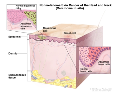 Nonmelanoma skin cancer of the head and neck (carcinoma in situ); drawing shows abnormal squamous cells and basal cells in the epidermis. Also shown are the dermis and the subcutaneous tissue below the dermis. There are two insets: the inset on the left shows a close up of normal and abnormal squamous cells; the inset on the right shows a close up of normal and abnormal basal cells.