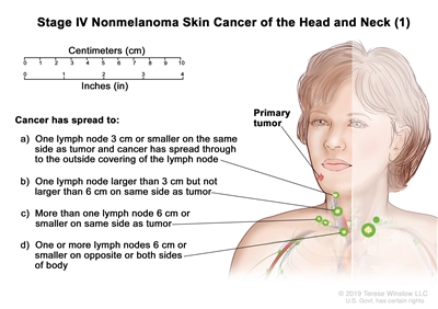Stage IV nonmelanoma skin cancer of the head and neck (1); drawing shows a primary tumor on the face and cancer that has spread to: (a) one lymph node on the same side of the body as the tumor, the node is 3 centimeters or smaller, and cancer has spread through to the outside covering of the lymph node; (b) one lymph node on the same side of the body as the tumor and the node is larger than 3 centimeters but not larger than 6 centimeters; (c) more than one lymph node on the same side of the body as the tumor and the nodes are 6 centimeters or smaller; and (d) one or more lymph nodes on the opposite or both sides of the body as the tumor and the nodes are 6 centimeters or smaller. Also shown is a 10-centimeter ruler and a 4-inch ruler.