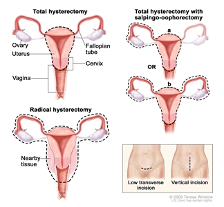 Hysterectomy; drawing shows the female reproductive anatomy, including the ovaries, uterus, vagina, fallopian tubes, and cervix. Dotted lines show which organs and tissues are removed in a total hysterectomy, a total hysterectomy with salpingo-oophorectomy, and a radical hysterectomy. An inset shows the location of two possible incisions on the abdomen: a low transverse incision is just above the pubic area and a vertical incision is between the navel and the pubic area.
