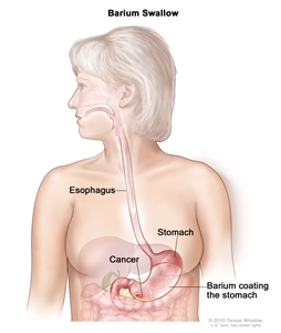 Barium swallow for stomach cancer; drawing shows barium liquid flowing through the esophagus and into the stomach.