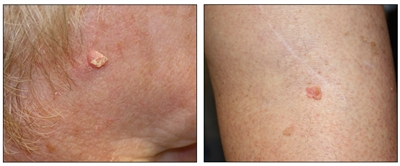 Photographs showing a pink, raised lesion on the skin of the face (left panel) and on the skin of the leg (right panel).