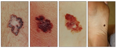 Photographs showing a brown lesion with a large and irregular border on the skin (panel 1); large, asymmetrical, red and brown lesions on the skin (panels 2 and 3); and an asymmetrical, brown lesion on the skin on the bottom of the foot (panel 4).