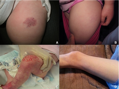 Photographs showing (A) presentation and (B) resolution of an infantile hemangioma in patient 4 (upper left and right photos), and (C) presentation and (D) resolution of an infantile hemangioma in patient 5 (bottom left and right photos).
