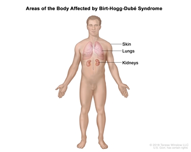 Drawing showing areas of the body affected by Birt-Hogg-Dube syndrome, including the skin, lungs, and kidneys.