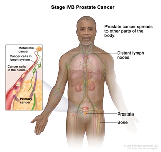 Stage IVB prostate cancer; drawing shows other parts of the body where prostate cancer may spread, including the distant lymph nodes and bones. An inset shows cancer cells spreading from the prostate, through the blood and lymph system, to another part of the body where metastatic cancer has formed.