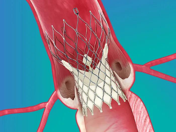 tavr stroke blue cardiovascular red inside blue background