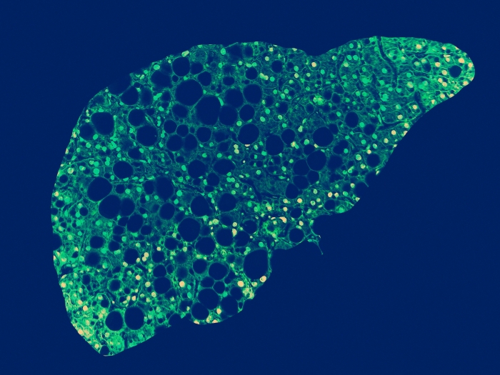 liposomal glutathione nafld liver disease study 8 Ways to Boost Your Glutathione Levels Naturally