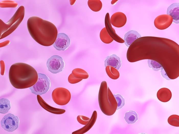 sickle cell gene therapy pink