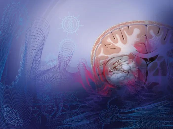 Scientific illustration of gliobastoma cells in the brain