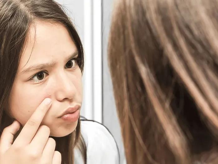 Acne your child