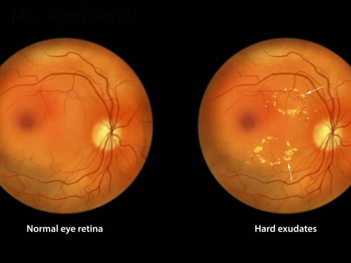 two photos of the back of an eye 